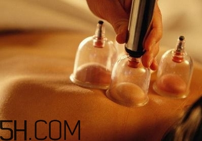 拔罐可以治療鼻炎嗎？鼻炎拔罐拔哪里？