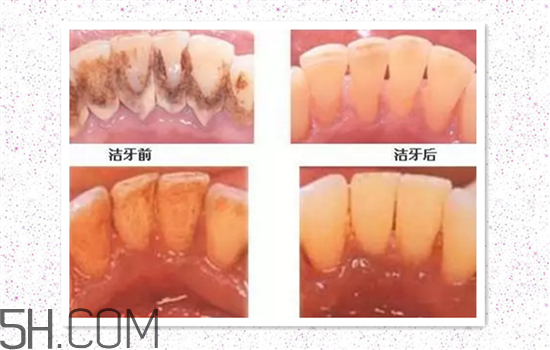 超聲波洗牙可以美白牙齒嗎？超聲波洗牙多少錢一次？