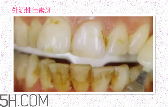 超聲波洗牙可以美白牙齒嗎？超聲波洗牙多少錢一次？