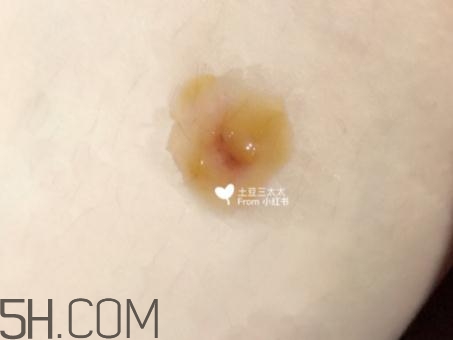 美寶濕潤燒傷膏怎么樣？美寶濕潤燒傷膏有用嗎？