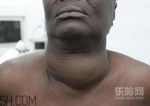 甲狀腺腫大和甲亢的區(qū)別有哪些？甲狀腺腫大適合吃什么食物？