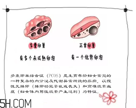 多囊卵巢生不了？多囊卵巢懷孕要看準(zhǔn)時(shí)間