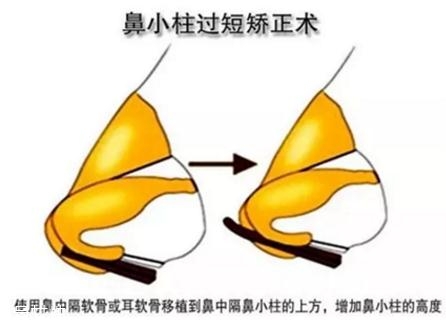 鼻小柱延長用什么材料？優(yōu)先選擇鼻中隔軟骨