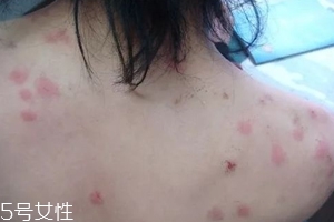 螨蟲有哪些危害？嚴(yán)重時肌膚糜爛