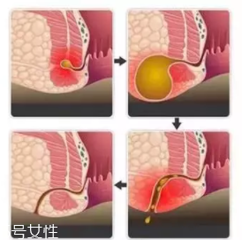 肛瘺非手術治療才可以嗎？手術是治療的關鍵途徑