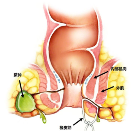 肛瘺非手術治療才可以嗎？手術是治療的關鍵途徑