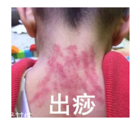 吮痧有什么療效？最溫柔的治病方法