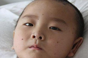 痣什么情況下會(huì)轉(zhuǎn)變?yōu)榱?？點(diǎn)痣不可取