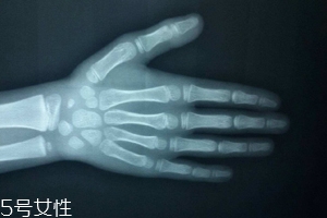 哪些人需要測骨齡？長太快警惕骨齡提前