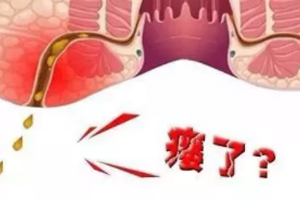 肛瘺非手術(shù)治療才可以嗎？手術(shù)是治療的關(guān)鍵途徑