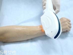 激光脫毛需要幾次？激光脫毛并不是終身有效的