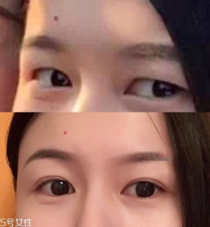 內(nèi)雙怎么進化成雙眼皮？全是雙眼皮貼的功勞