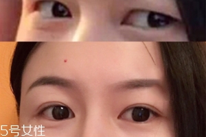 內(nèi)雙怎么進化成雙眼皮？全是雙眼皮貼的功勞