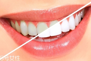 牙齒發(fā)黃是天生的嗎？只是你刷牙偷懶了