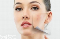 痘印多久能自行消失？多數(shù)人一年內(nèi)消失