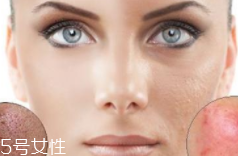 痘印多久能自行消失？多數(shù)人一年內(nèi)消失