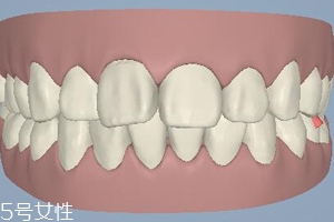 磨牙有哪些癥狀？牙齒變形甚至脫落