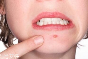肌膚需要排毒嗎？長痘并不代表排毒