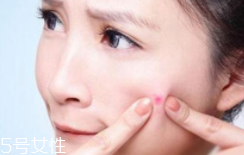 肌膚需要排毒嗎？長痘并不代表排毒