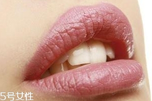 冬天爛嘴角什么原因？有可能營(yíng)養(yǎng)不良