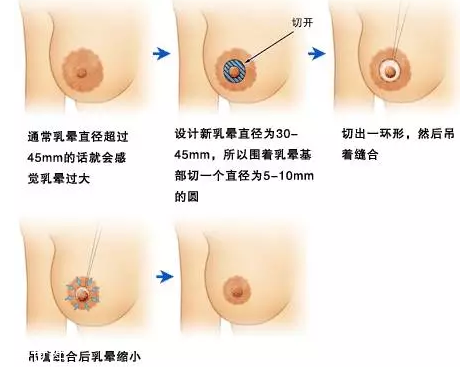 乳暈縮小術(shù)怎么做？乳暈縮小術(shù)知識全解