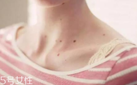 色素痣是腫瘤嗎？良性腫瘤不必?fù)?dān)心