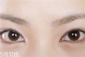 割雙眼皮后怎樣恢復(fù)快？女人不能割雙眼皮的時(shí)期