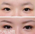 開眼角疤痕多久消失？開眼角的適宜人群