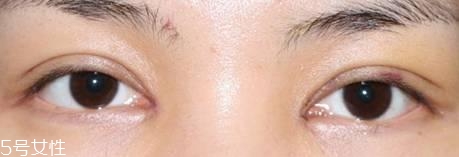 怎么縮短開眼角疤痕消失時(shí)間？雙眼皮開眼角恢復(fù)過程