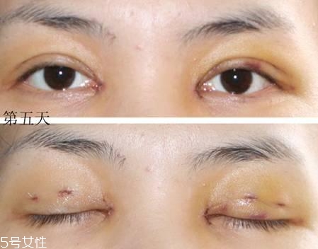 怎么縮短開眼角疤痕消失時(shí)間？雙眼皮開眼角恢復(fù)過程