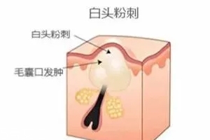 閉口是怎么引起的？4種情況要注意