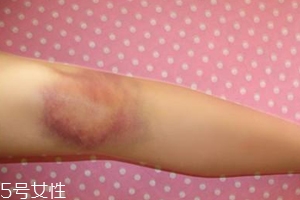身體淤青怎么來的？不是磕碰那么簡單