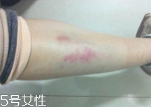 摔傷了涂什么藥好的快？做好消毒才能愈合快