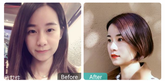 下瞼整形多久能恢復自然？半年時間