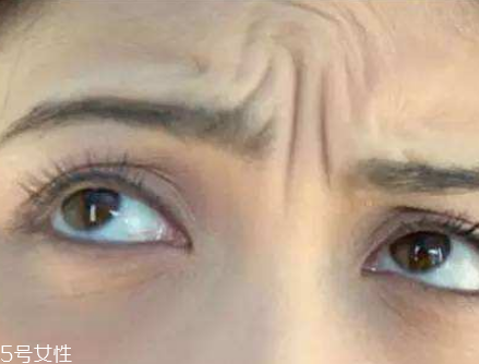 川字紋可以手術(shù)去除嗎？選擇手術(shù)需謹(jǐn)慎