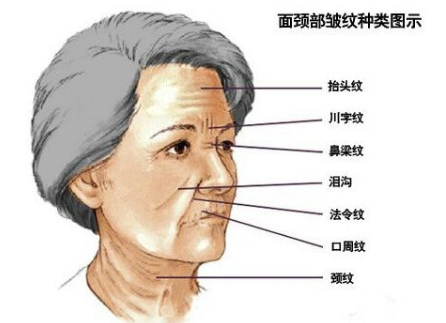 川字紋可以打玻尿酸嗎？不是最佳選擇