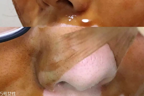 雪花秀撕拉面膜怎么撕出黑頭？這么做才能去黑頭
