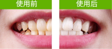 牙貼怎么分上下牙貼？牙貼怎么分正反