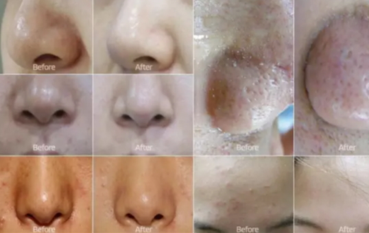 弄完小氣泡多久可以化妝？小氣泡注意事項(xiàng)