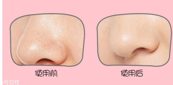 yoii黑頭儀怎么用？yoii黑頭儀怎么充電