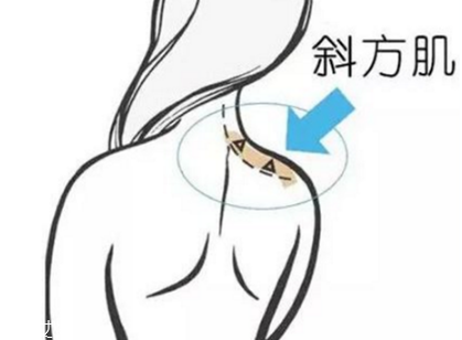 瘦肩針間隔多久打一次？打瘦肩針間隔時間