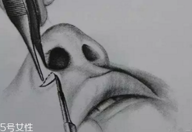鼻翼外切多久消腫？鼻翼外切消腫時(shí)間要多長？