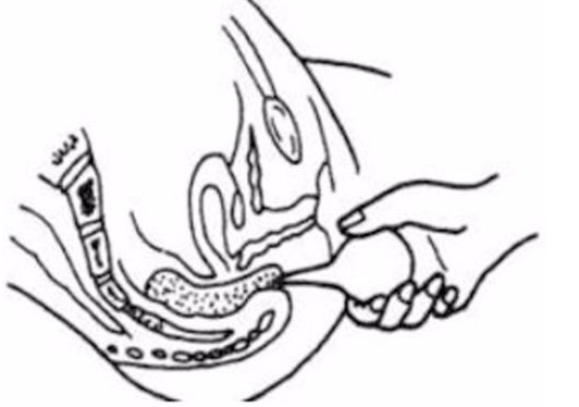 開塞露躺著還是蹲著用？開塞露使用姿勢(shì)