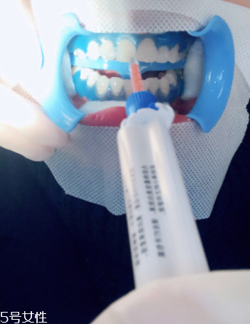 冷光美白會反彈嗎？冷光美白心得