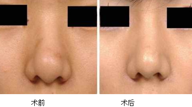 縮鼻手術(shù)多久恢復(fù)？縮鼻手術(shù)傷口才會(huì)好