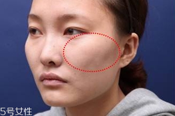 顴骨墊高手術(shù)多久能恢復 顴骨墊高多久能看到完整效果