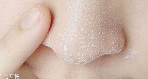 黑頭不管它會變大嗎？黑頭不管它會怎樣？