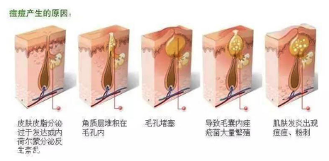頑固痘痘怎么消除？油皮為什么反復(fù)爆痘？