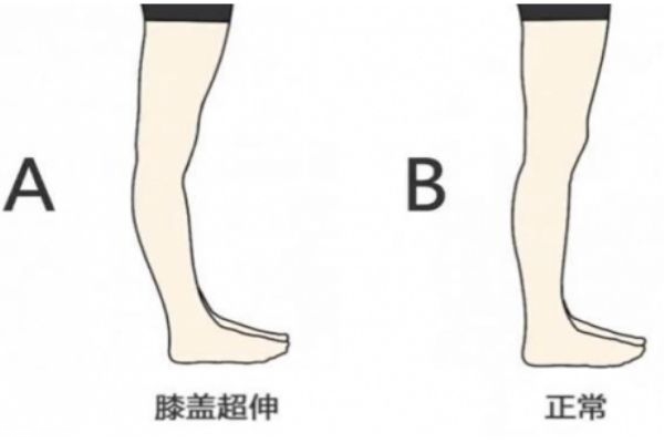 膝關節(jié)超伸的表現 快來自測一下把