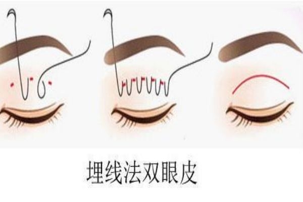 埋線(xiàn)雙眼皮感染怎么辦？埋線(xiàn)雙眼皮發(fā)炎了怎么辦